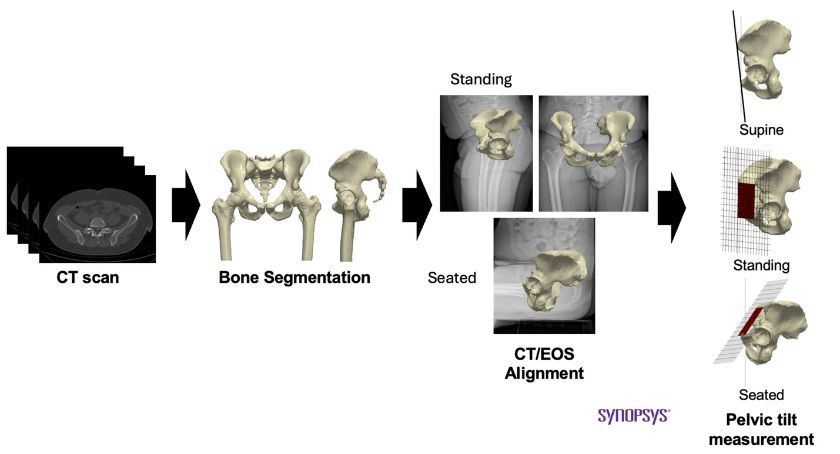 A Bimodal Imaging Workflow for Functional Spino-Pelvic Assessment